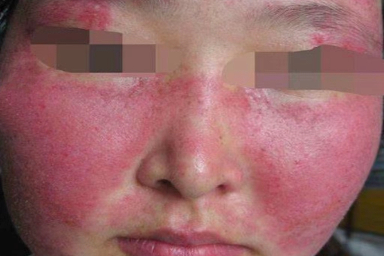 混合结缔组织病面部红斑图