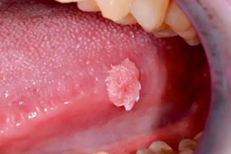 口腔尖锐湿疣图 口腔尖锐湿疣图