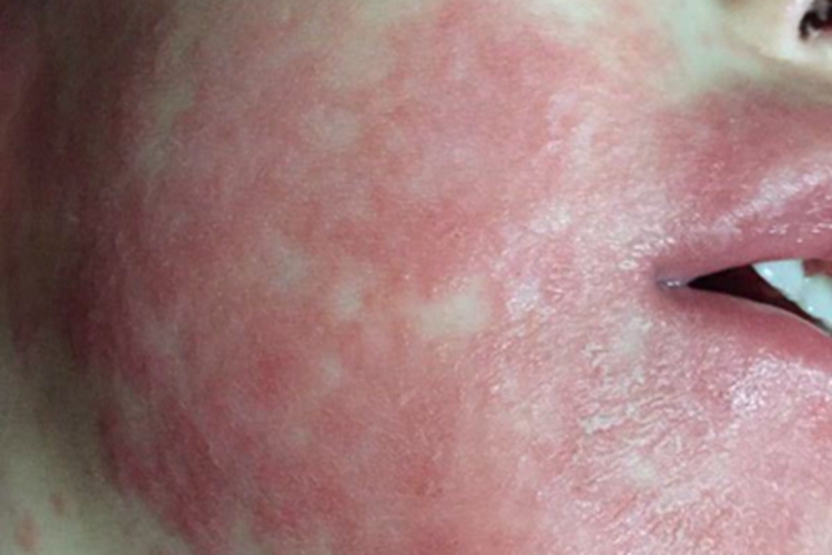 重症多形红斑面部丘疹图