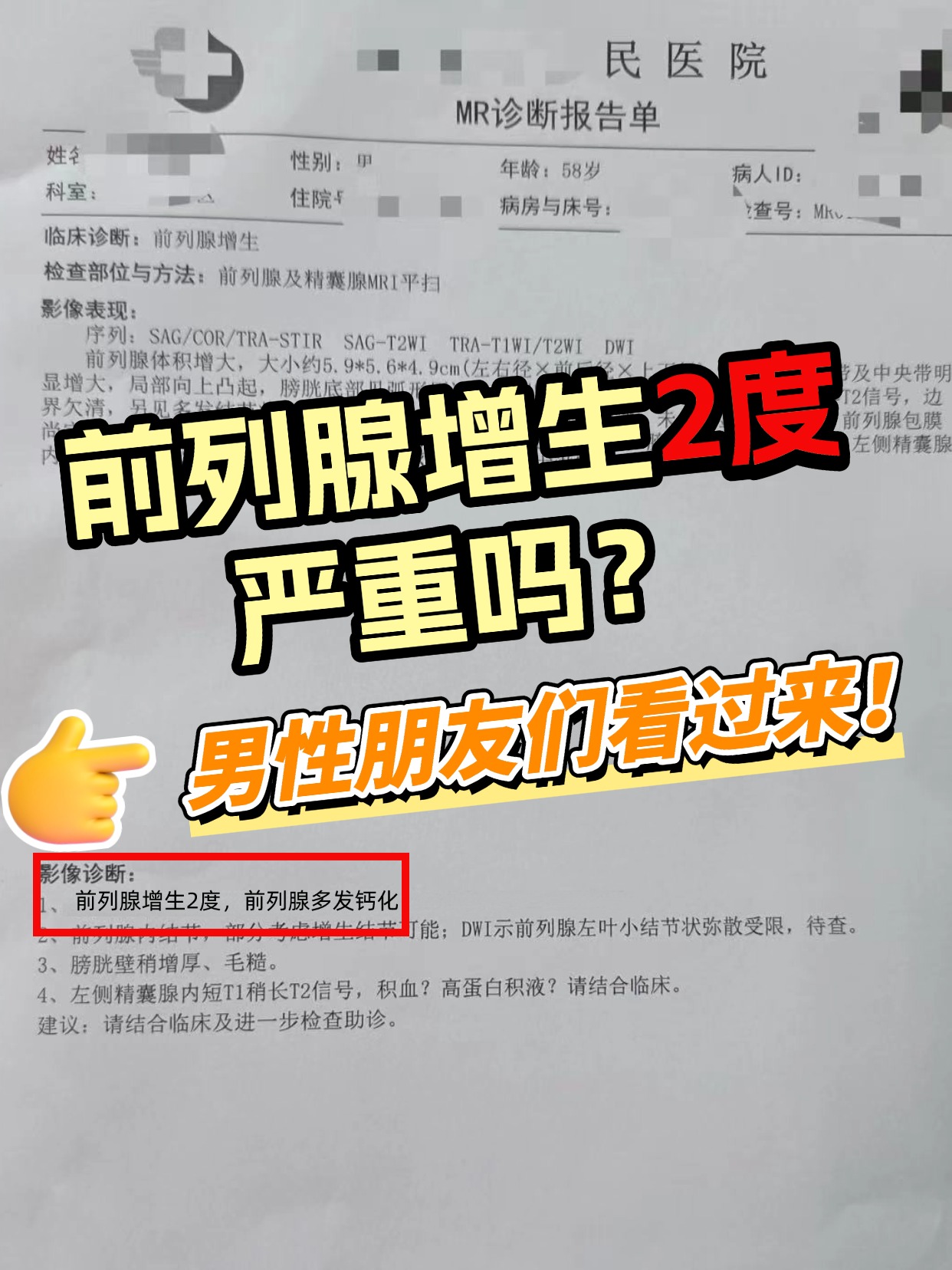前列腺增生2度，严重吗？男性朋友们看过来！