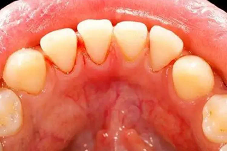 血小板减少性紫癜牙龈出血图