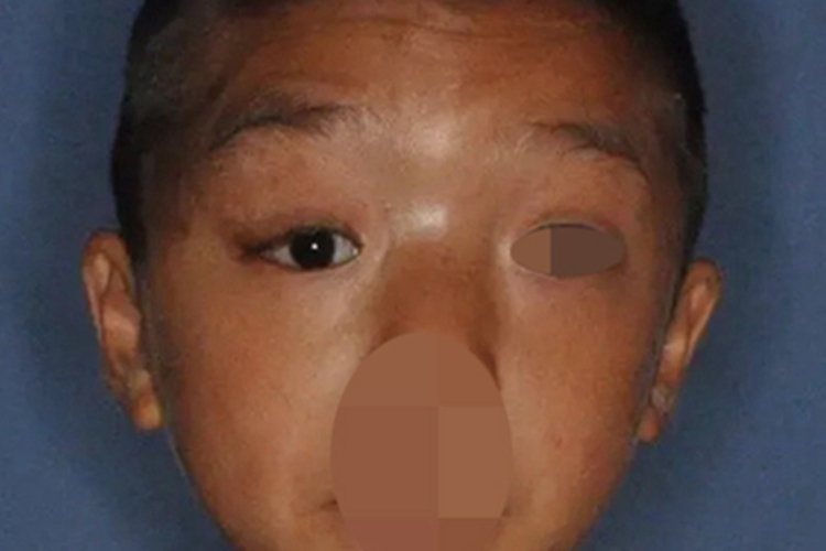 上睑下垂眼睑症状图