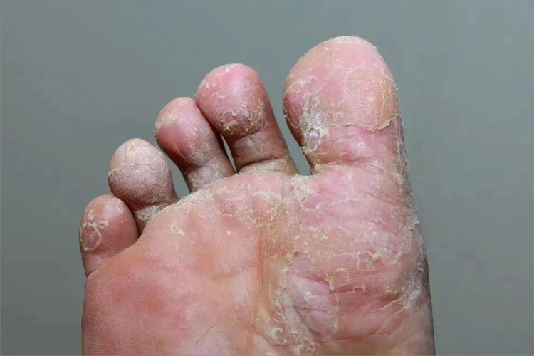 鳞屑角化型足癣脚趾脱屑图 鳞屑角化型足癣脚趾脱屑图