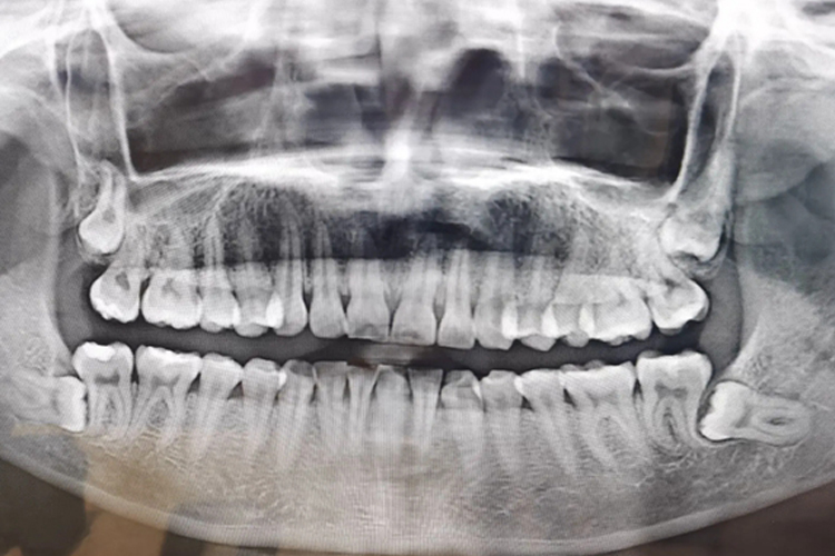 下颌低位阻生智齿图