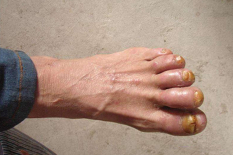 银屑病关节炎增厚图