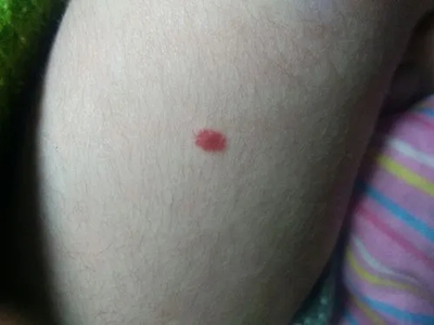 樱桃状血管瘤腿上有个红斑图.jpeg
