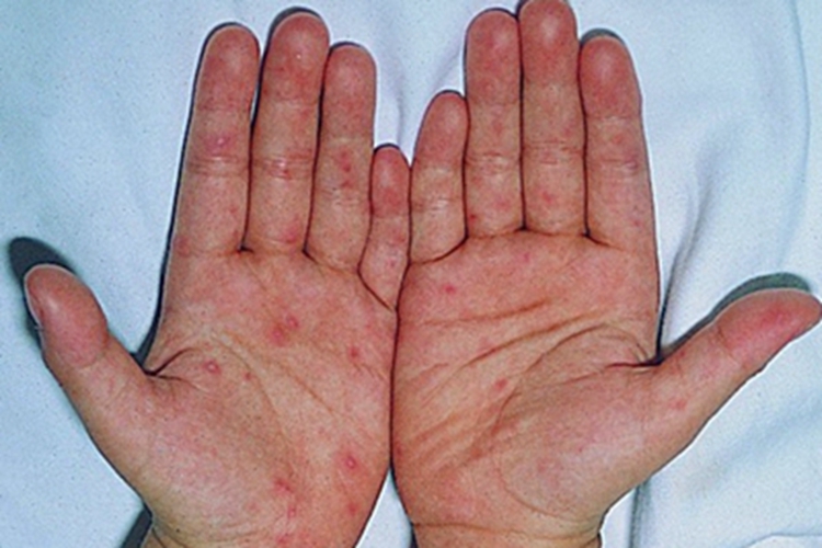 接触性皮炎手掌症状图 接触性皮炎手掌症状图