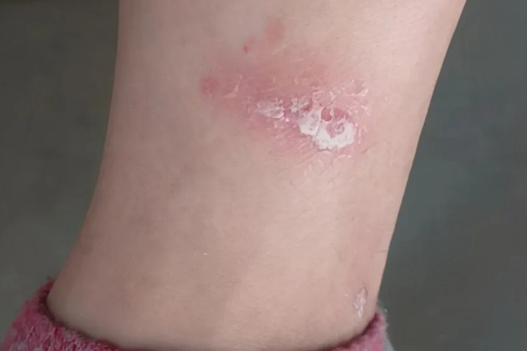 轻度寻常型银屑病图