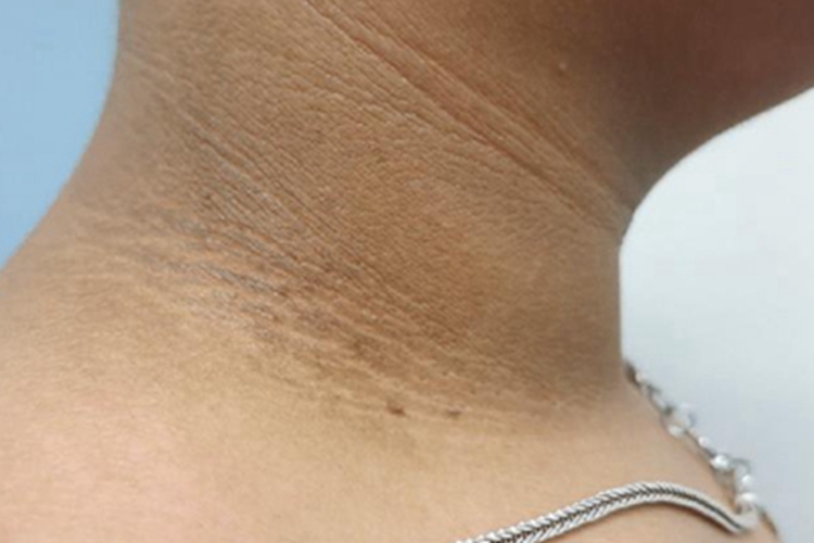 假性黑棘皮病颈部症状图