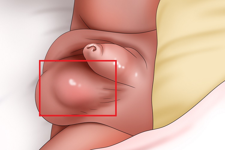 精索鞘膜积液手绘图