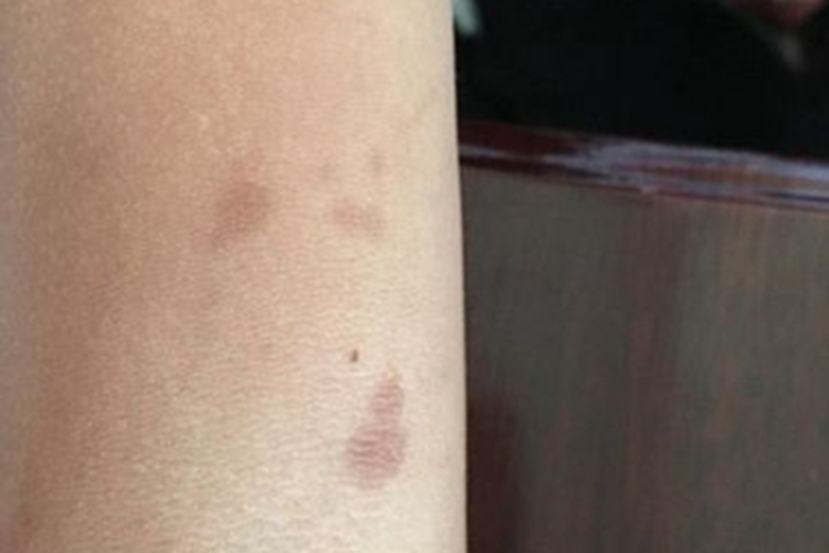 咖啡斑手臂有几块咖啡色斑图