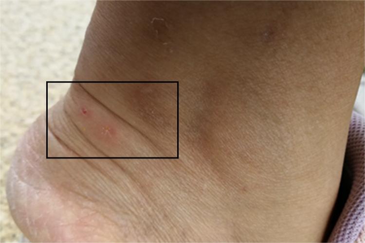 光化性痒疹脚后跟丘疹图