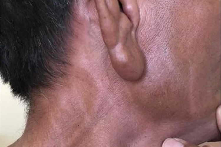 瘤型麻风耳部症状图