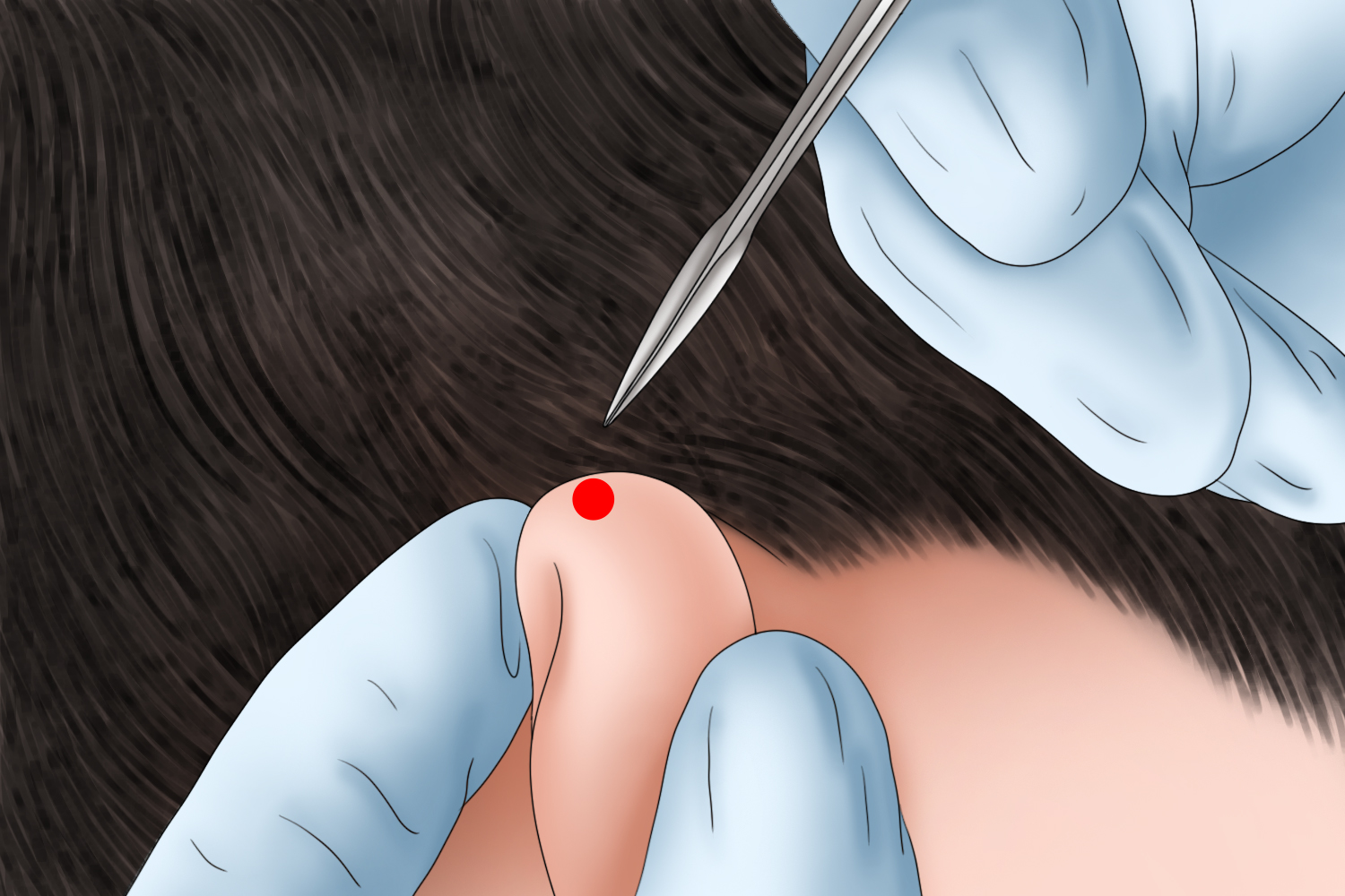 刺络放血三棱针针刺图