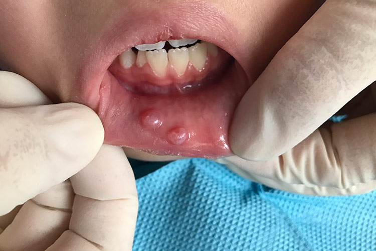 下唇黏液腺囊肿图 下唇黏液腺囊肿图