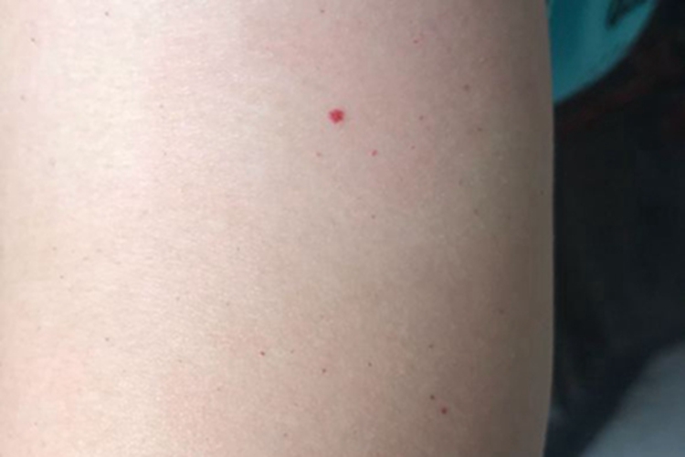 樱桃状血管瘤大腿红点图