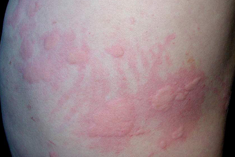 伴有抓痕的螨虫皮炎图