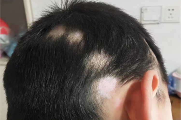 稳定期节段型白癜风头皮症状图 稳定期节段型白癜风头皮症状图