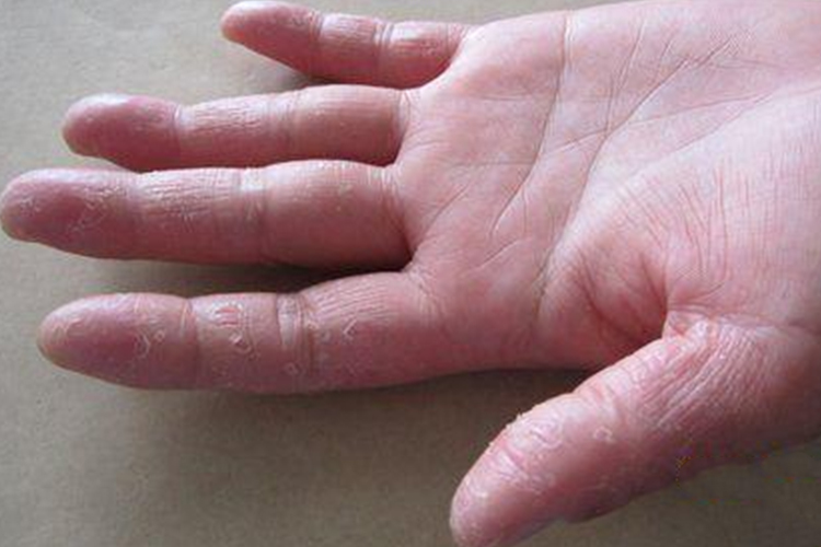 手剥银杏果外皮手指脱皮图 手剥银杏果外皮手指脱皮图