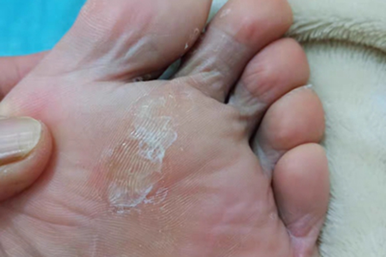胼胝脚底皮肤增厚发黄图 胼胝脚底皮肤增厚发黄图