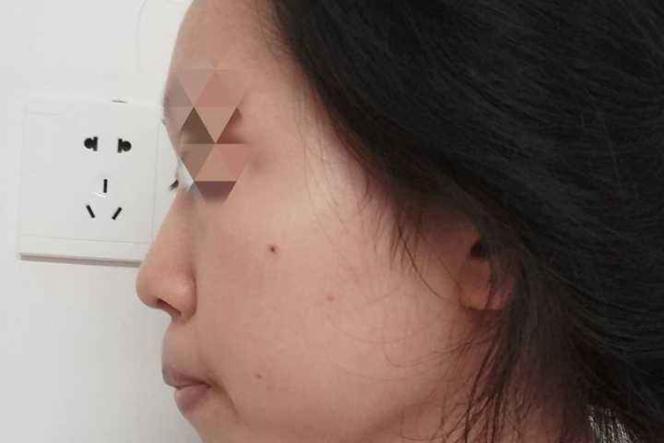 大人腺样体肥大面容图