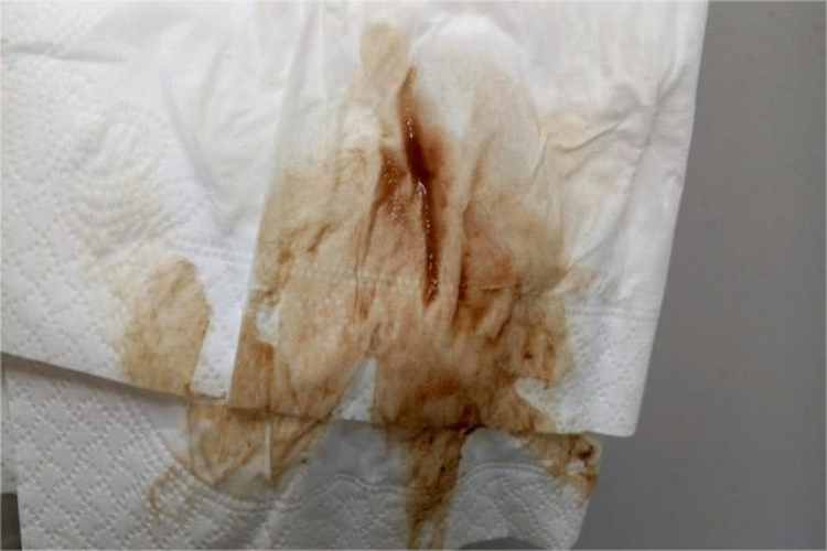 先兆流产出血图