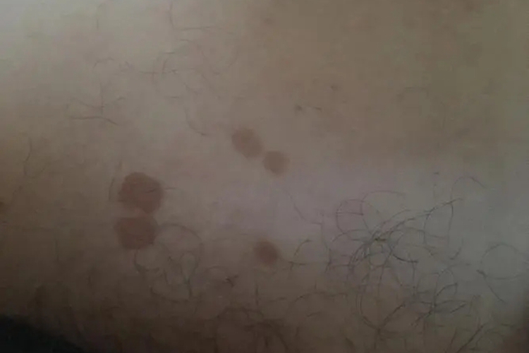 大腿根部咖啡斑图