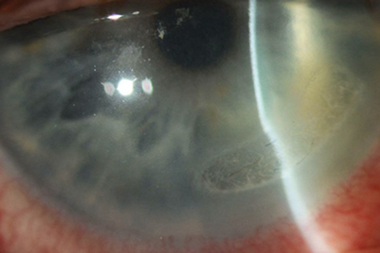 角膜软化症角膜混浊图 角膜软化症角膜混浊图