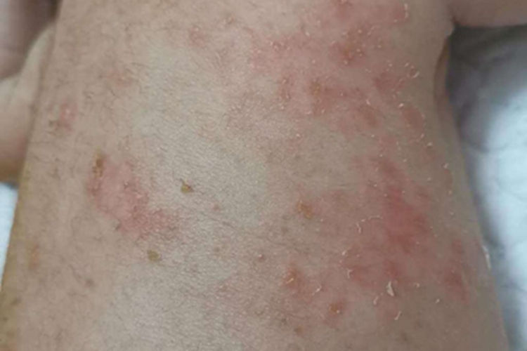 新生儿痤疮脱屑图 新生儿痤疮脱屑图