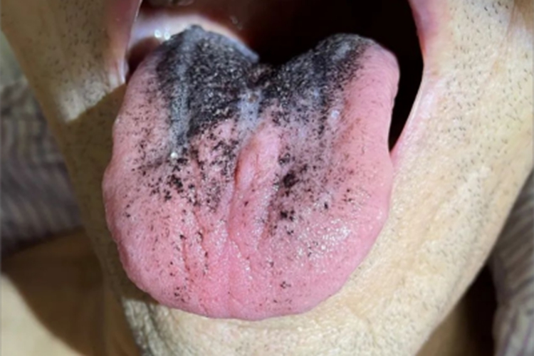 黑毛舌舌苔发黑变厚图