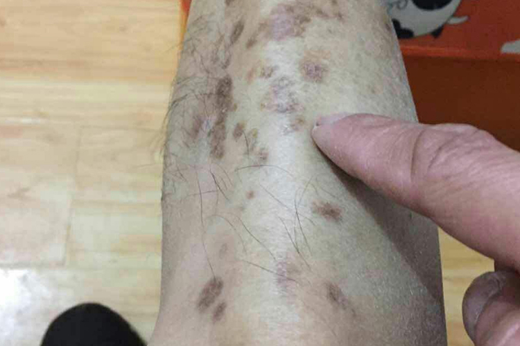 糖尿病人小腿黑斑图