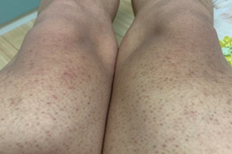 Kyrle病大腿症状图