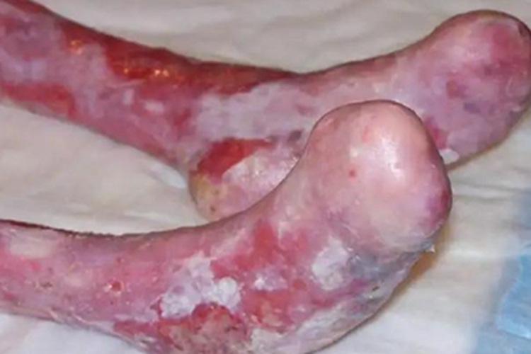 大疱性表皮松解症脚部畸形图 大疱性表皮松解症脚部畸形图