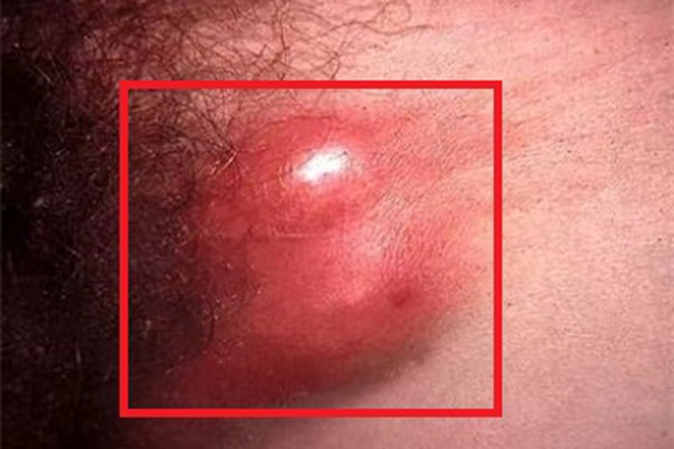 女性中期性病性淋巴肉芽肿大包图