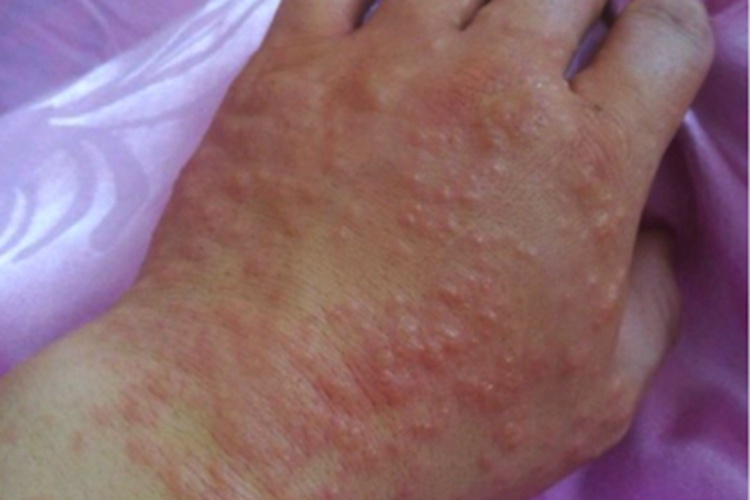 色素性痒疹手背丘疹图 色素性痒疹手背丘疹图