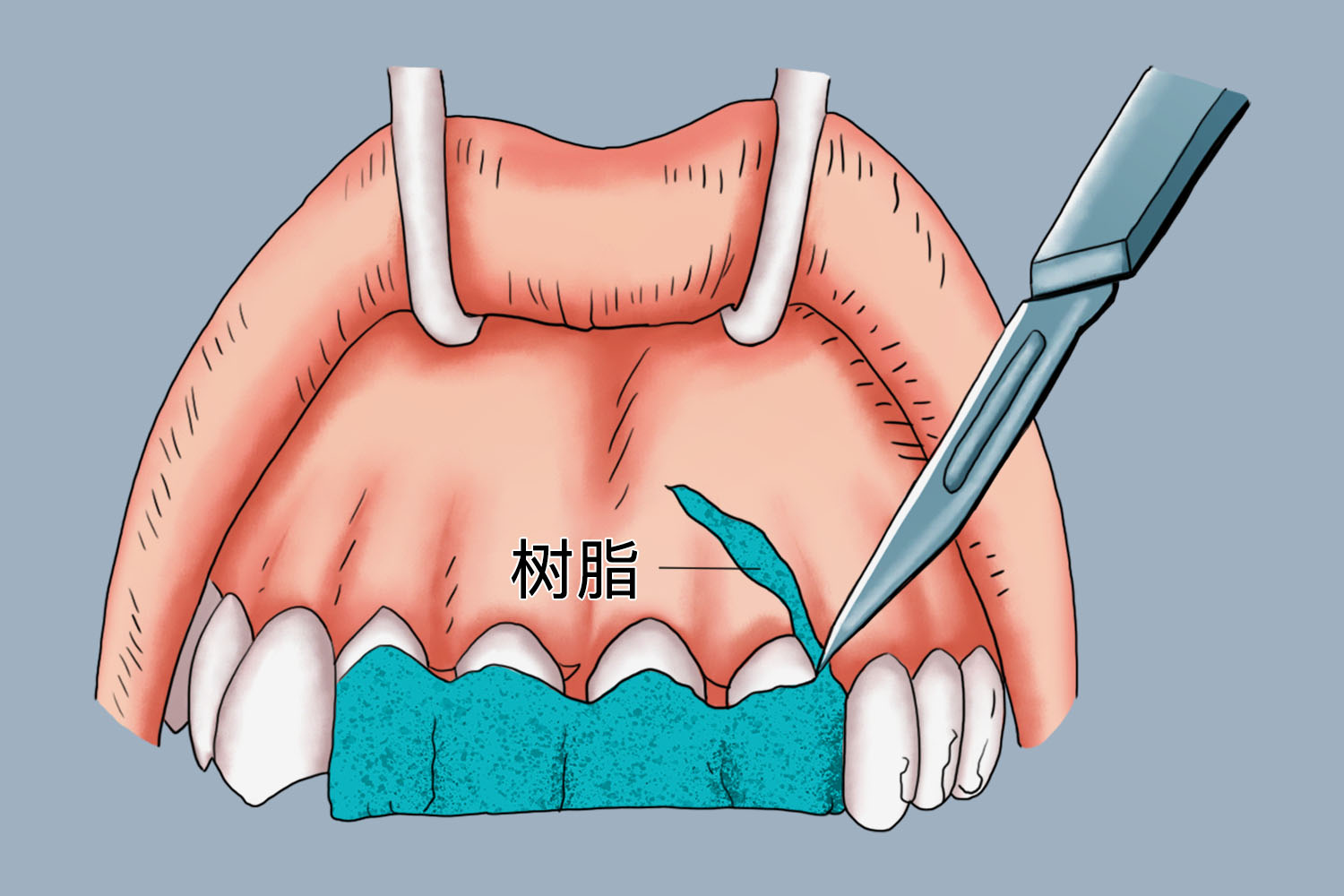 松牙固定术步骤图片