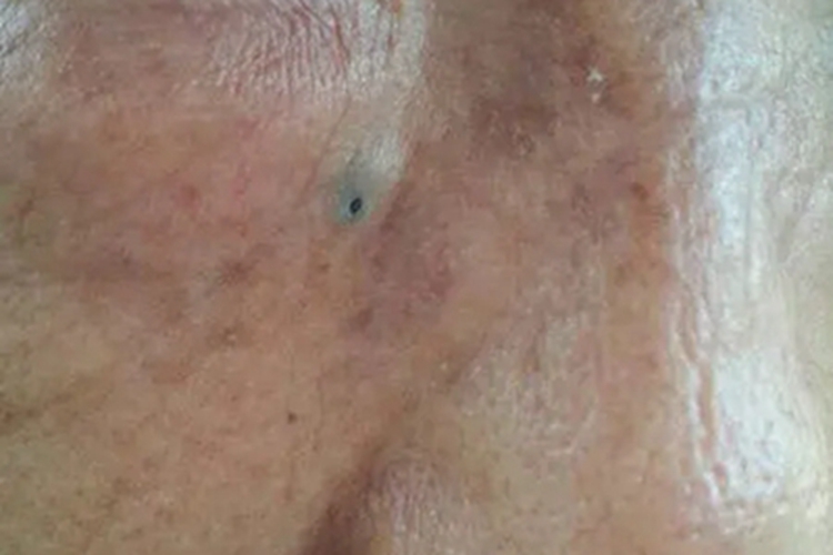 扩张孔脸上鼓包有黑色小孔图