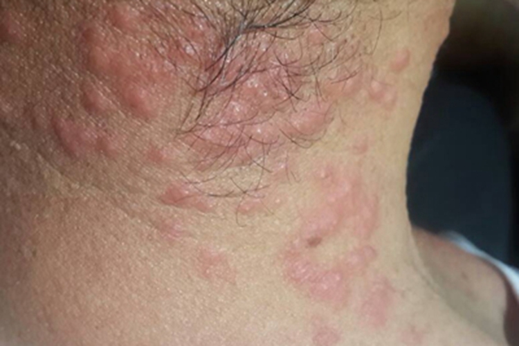 淋巴瘤样丘疹病颈部症状图 淋巴瘤样丘疹病颈部症状图