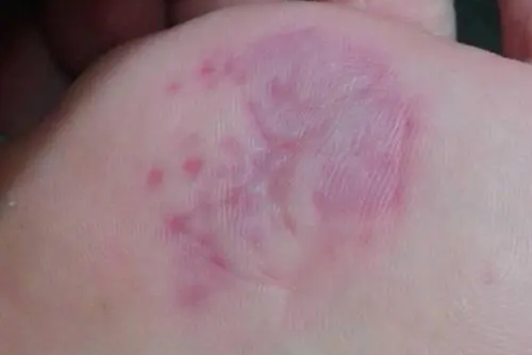 脚底过度摩擦图