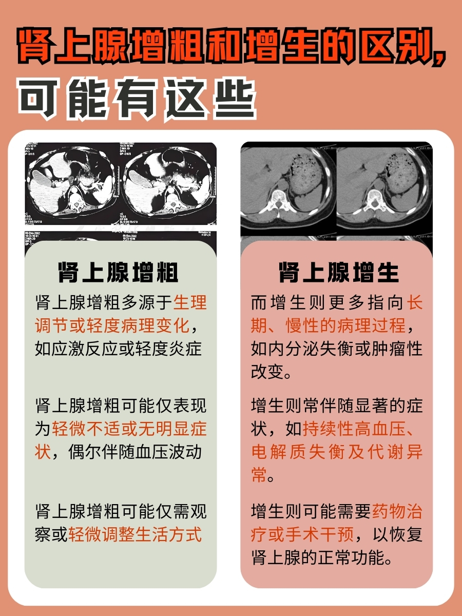 肾上腺增粗VS增生:一文带你了解两者的区别