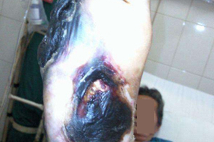 干性坏疽脚底大片发黑图