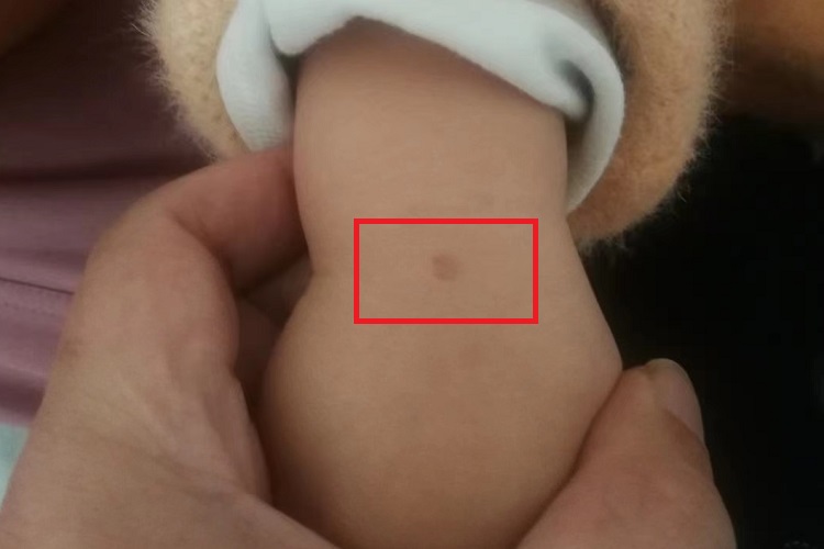 咖啡斑手腕斑图