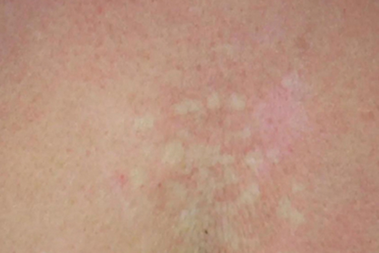 贫血痣胸部症状图