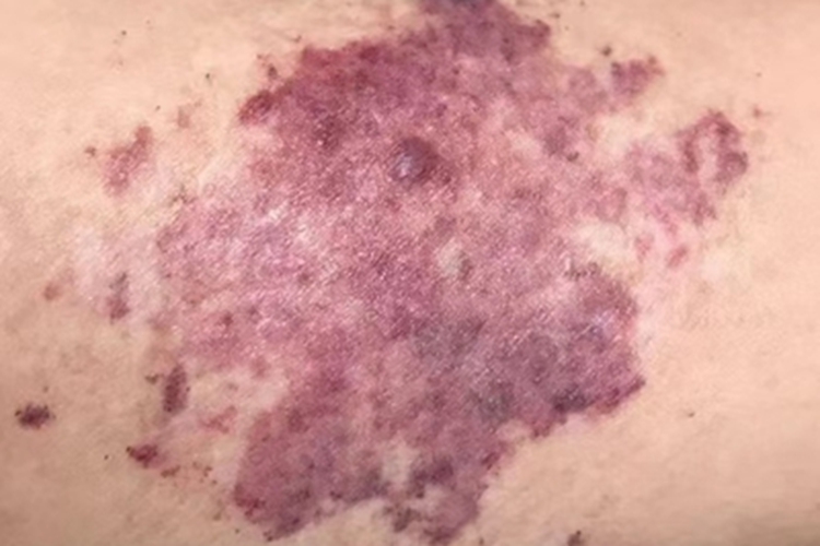 局限性血管角皮瘤大腿结节图 局限性血管角皮瘤大腿结节图