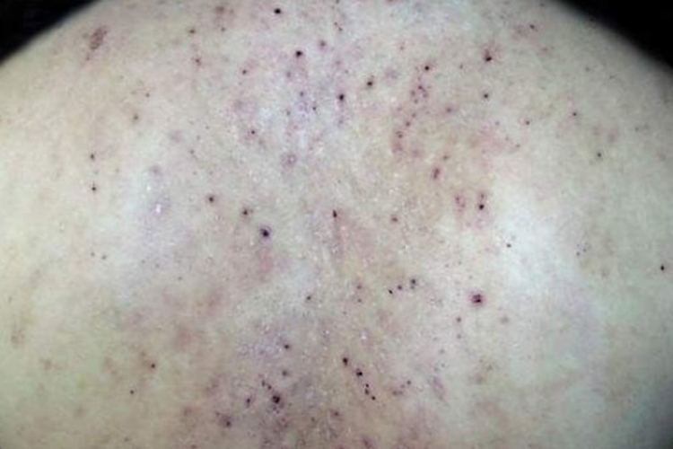 后背播散性神经性皮炎图