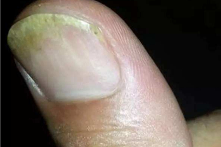 甲分离指甲分离后发黄图 甲分离指甲分离后发黄图