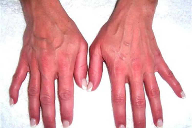 红斑性肢痛症手背红肿图