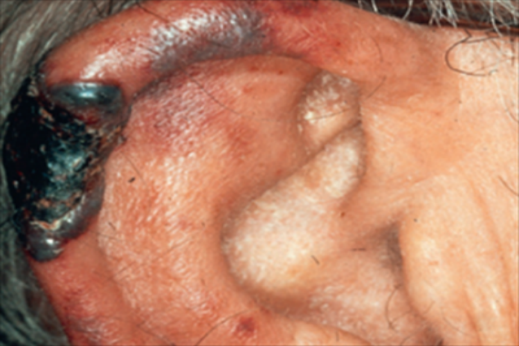 抗磷脂综合征耳部红肿图