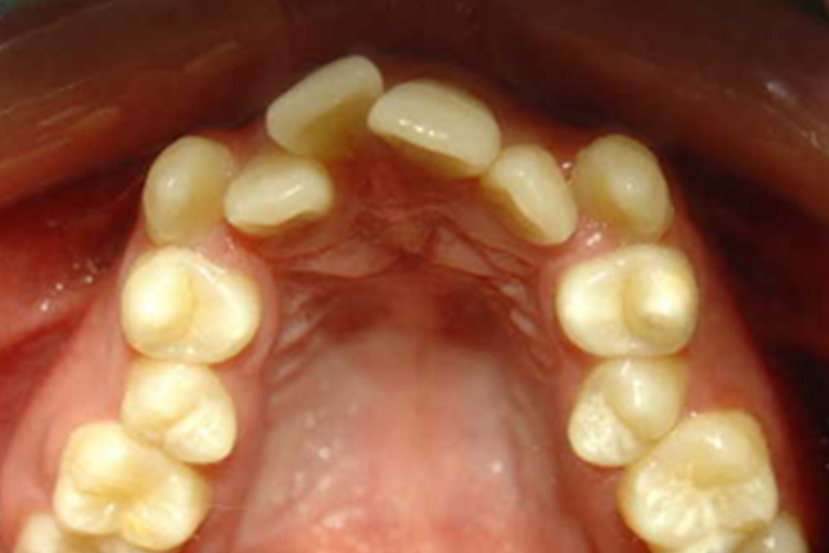 牙齿排列异常图
