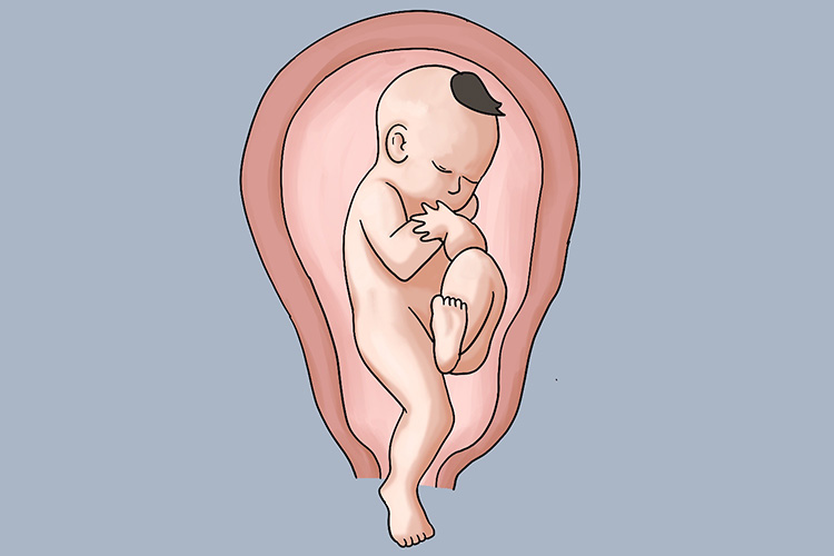 胎儿足先露图 胎儿足先露图